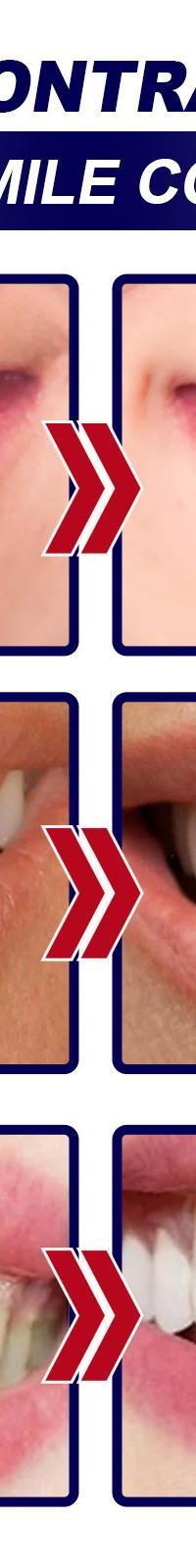 Eelhoe Whitening Strips for a Brighter Smile & Fresh Breath — side view